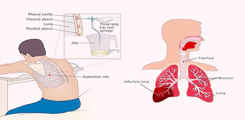 Chọc tháo dịch màng phổi